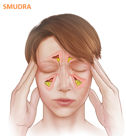 Acute sinusitis